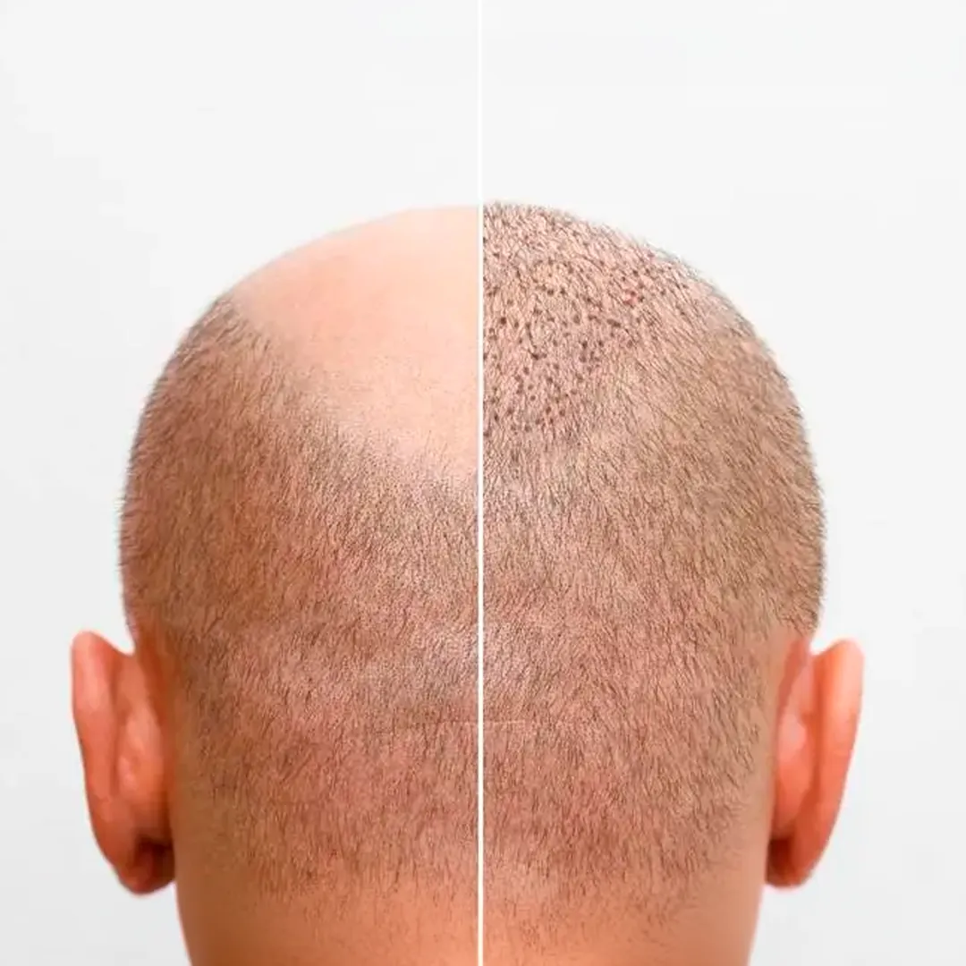 Comparação antes e depois de um transplante capilar vista de cima